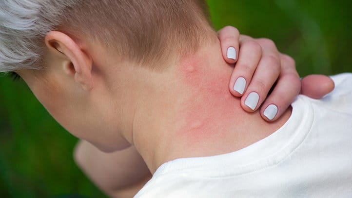 Stop the itching from bug bites